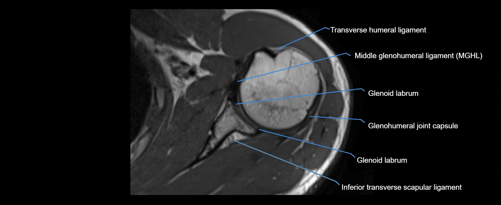 shoulder ligaments axial 3d 3t mri image-img-00005-00064.webp